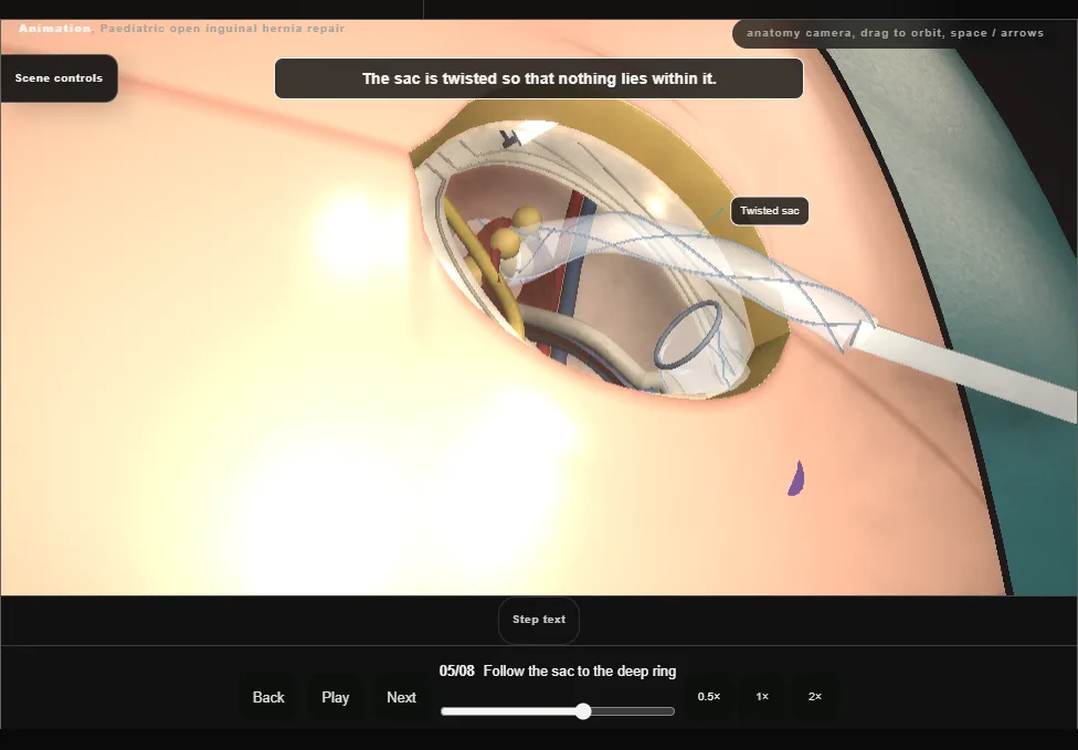 Paediatric open inguinal hernia repair. Step 5: Follow the sac to the deep ring. Captured frame from the interactive animation.