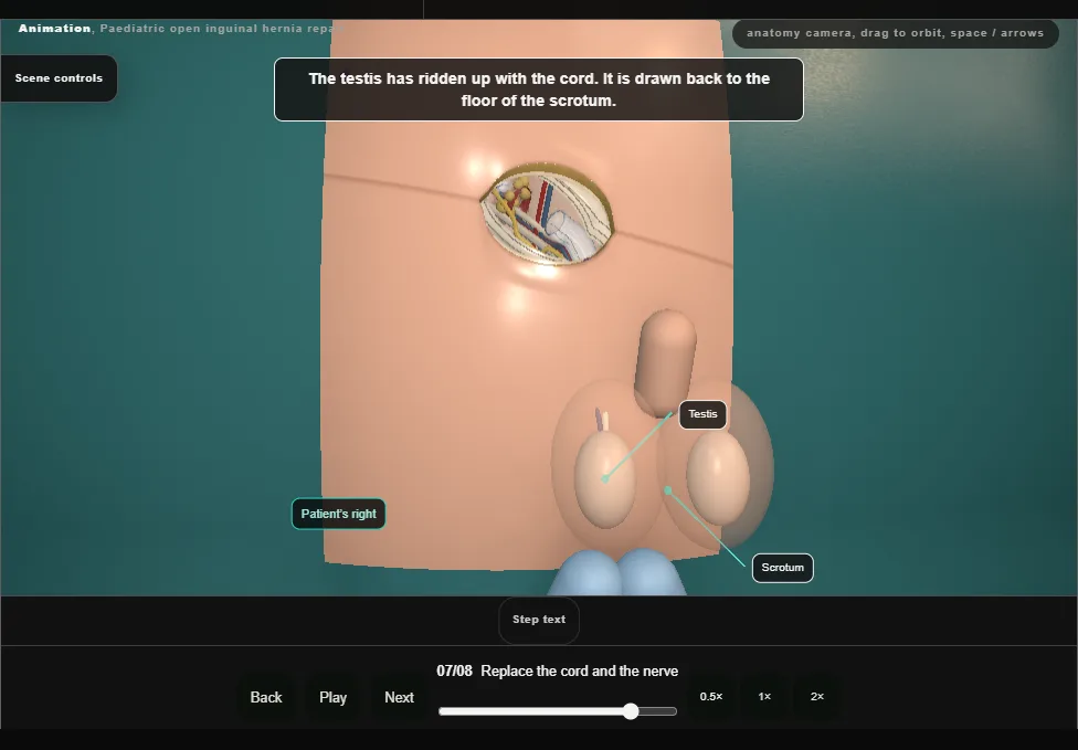 Paediatric open inguinal hernia repair. Step 7: Replace the cord and the nerve. Captured frame from the interactive animation.