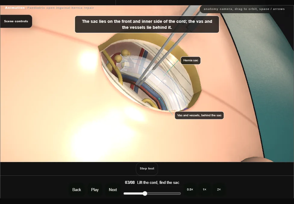 Paediatric open inguinal hernia repair. Step 3: Lift the cord, find the sac. Captured frame from the interactive animation.