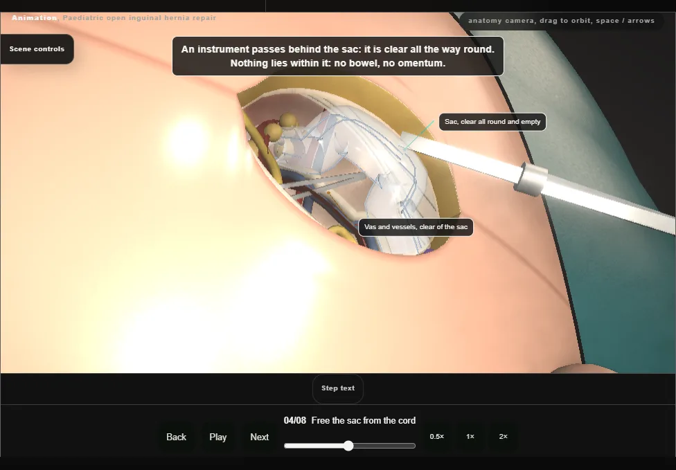 Paediatric open inguinal hernia repair. Step 4: Free the sac from the cord. Captured frame from the interactive animation.