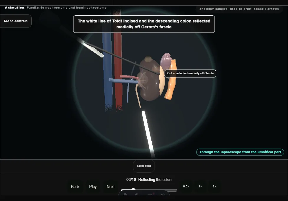 Paediatric nephrectomy and heminephrectomy. Step 3: Reflecting the colon. Captured frame from the interactive animation.