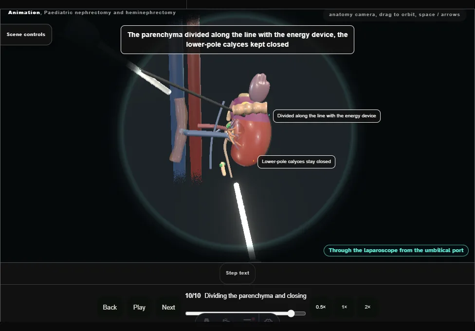 Paediatric nephrectomy and heminephrectomy. Step 10: Dividing the parenchyma and closing. Captured frame from the interactive animation.