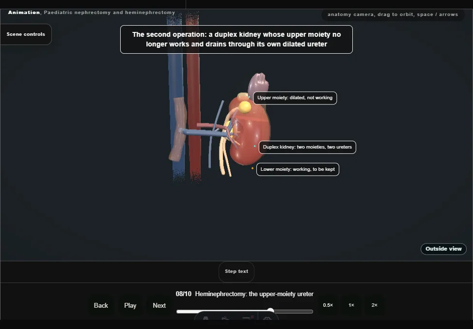 Paediatric nephrectomy and heminephrectomy. Step 8: Heminephrectomy: the upper-moiety ureter. Captured frame from the interactive animation.