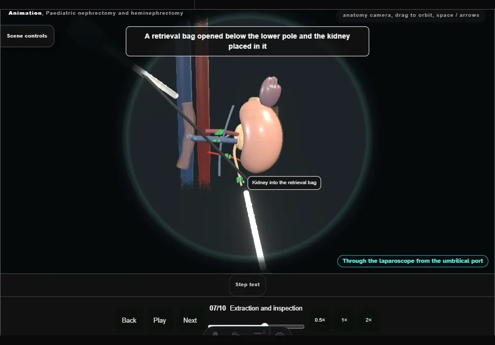 Paediatric nephrectomy and heminephrectomy. Step 7: Extraction and inspection. Captured frame from the interactive animation.