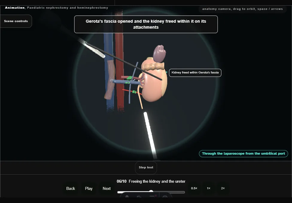 Paediatric nephrectomy and heminephrectomy. Step 6: Freeing the kidney and the ureter. Captured frame from the interactive animation.
