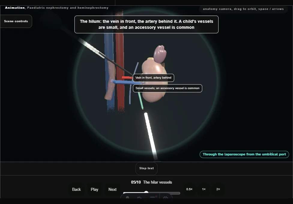 Paediatric nephrectomy and heminephrectomy. Step 5: The hilar vessels. Captured frame from the interactive animation.
