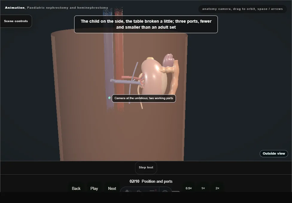 Paediatric nephrectomy and heminephrectomy. Step 2: Position and ports. Captured frame from the interactive animation.