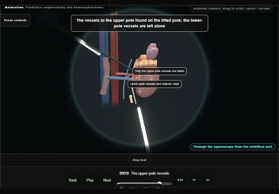 Paediatric nephrectomy and heminephrectomy. Step 9: The upper-pole vessels. Captured frame from the interactive animation.