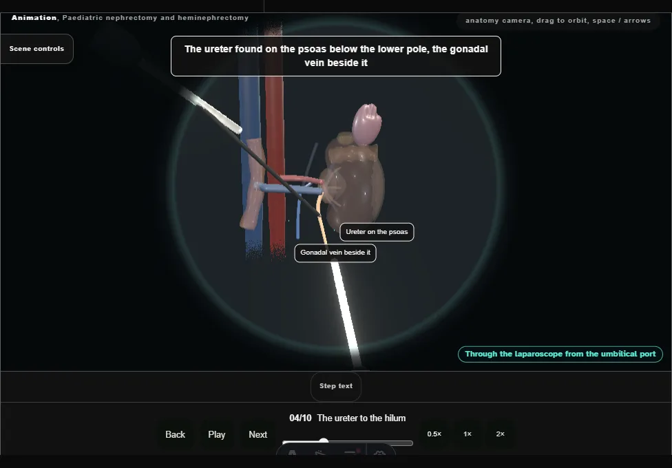 Paediatric nephrectomy and heminephrectomy. Step 4: The ureter to the hilum. Captured frame from the interactive animation.