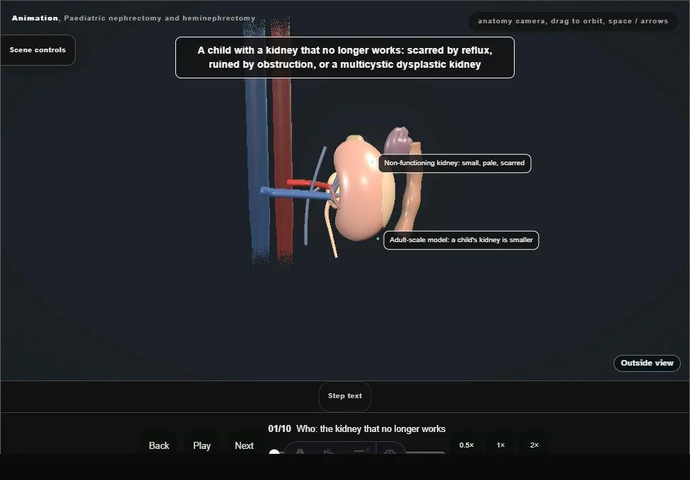Paediatric nephrectomy and heminephrectomy. Step 1: Who: the kidney that no longer works. Captured frame from the interactive animation.