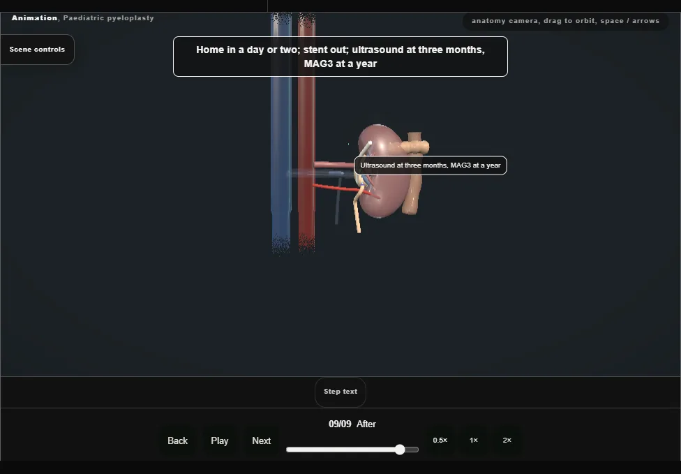 Paediatric pyeloplasty. Step 9: After. Captured frame from the interactive animation.
