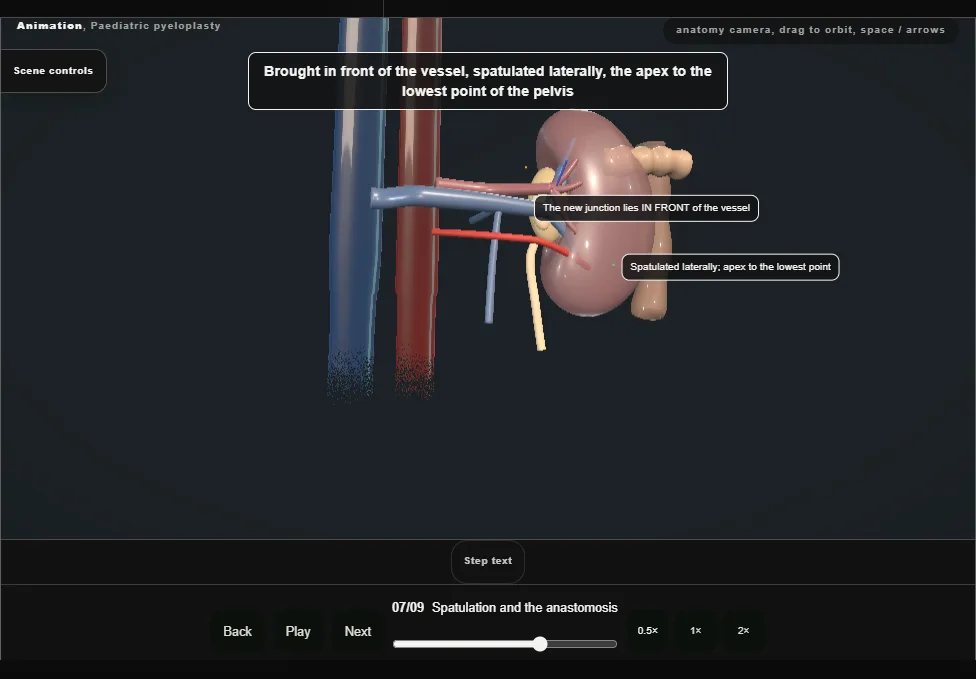 Paediatric pyeloplasty. Step 7: Spatulation and the anastomosis. Captured frame from the interactive animation.