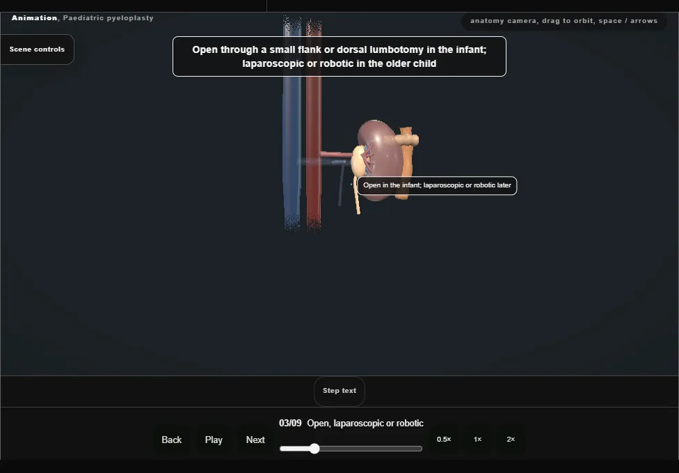 Paediatric pyeloplasty. Step 3: Open, laparoscopic or robotic. Captured frame from the interactive animation.
