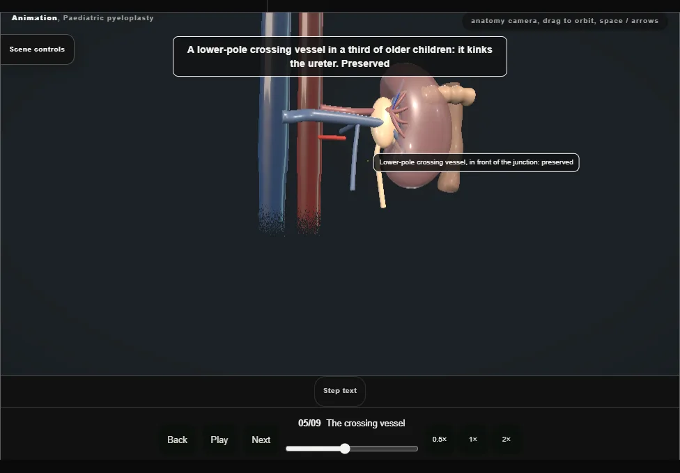 Paediatric pyeloplasty. Step 5: The crossing vessel. Captured frame from the interactive animation.