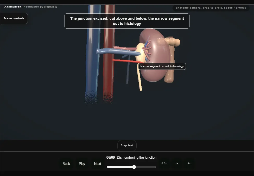 Paediatric pyeloplasty. Step 6: Dismembering the junction. Captured frame from the interactive animation.