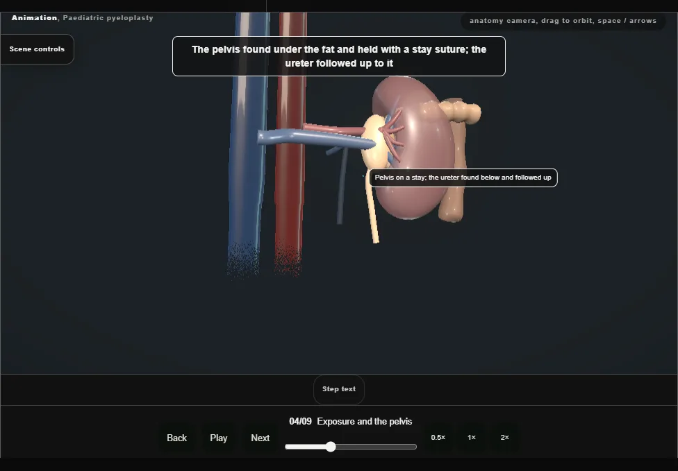 Paediatric pyeloplasty. Step 4: Exposure and the pelvis. Captured frame from the interactive animation.