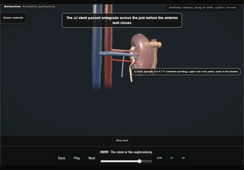 Paediatric pyeloplasty. Step 8: The stent or the nephrostomy. Captured frame from the interactive animation.