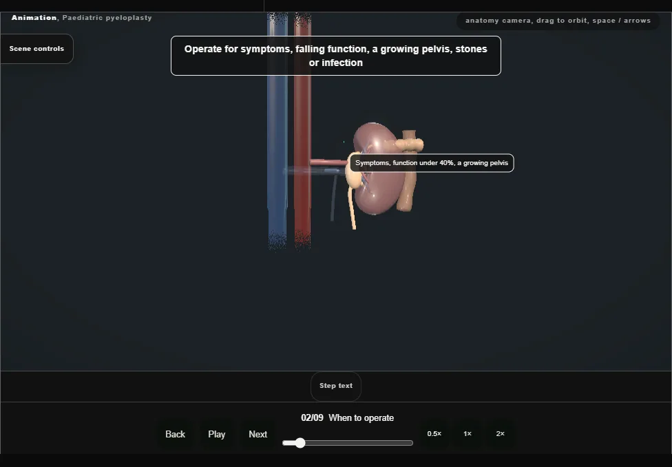 Paediatric pyeloplasty. Step 2: When to operate. Captured frame from the interactive animation.