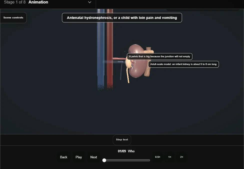 Paediatric pyeloplasty. Step 1: Who. Captured frame from the interactive animation.