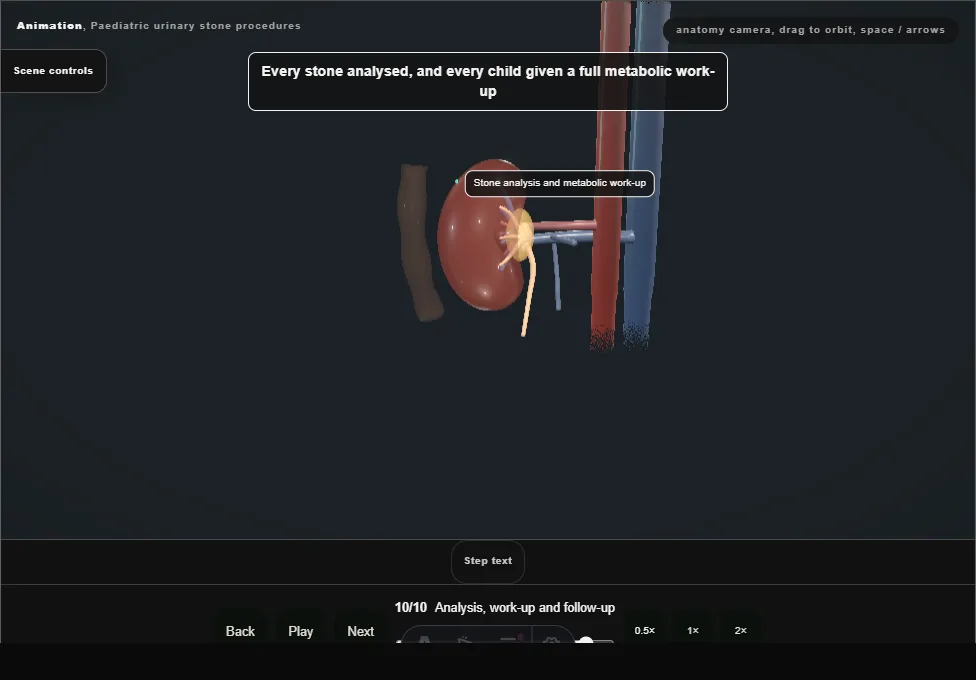 Paediatric urinary stone procedures. Step 10: Analysis, work-up and follow-up. Captured frame from the interactive animation.