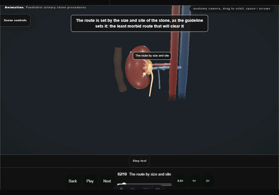 Paediatric urinary stone procedures. Step 2: The route by size and site. Captured frame from the interactive animation.