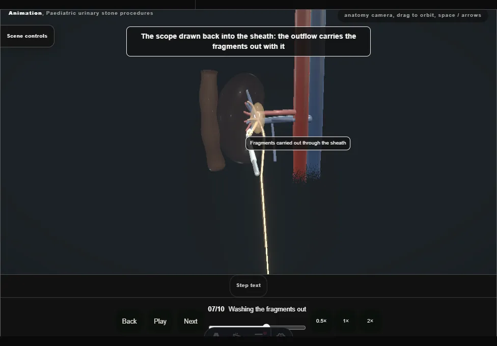 Paediatric urinary stone procedures. Step 7: Washing the fragments out. Captured frame from the interactive animation.