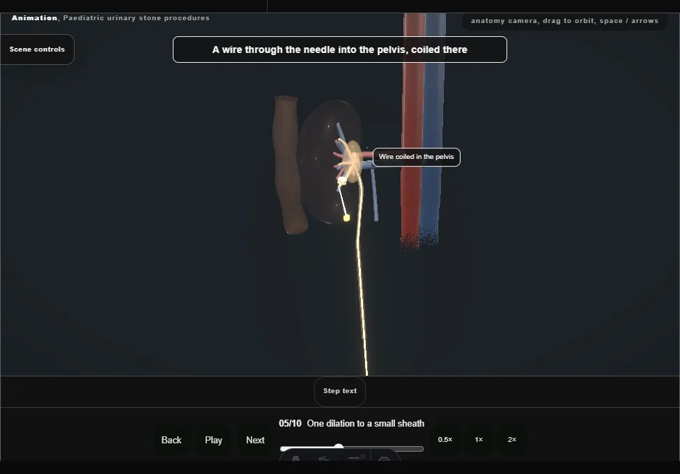 Paediatric urinary stone procedures. Step 5: One dilation to a small sheath. Captured frame from the interactive animation.