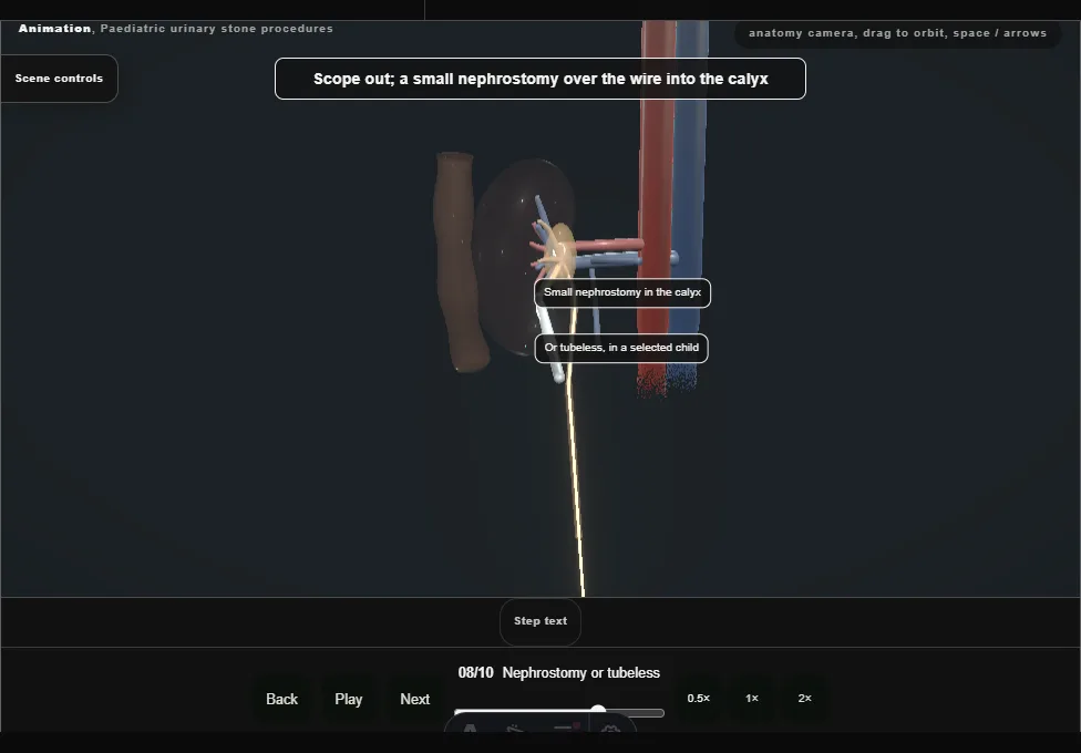 Paediatric urinary stone procedures. Step 8: Nephrostomy or tubeless. Captured frame from the interactive animation.