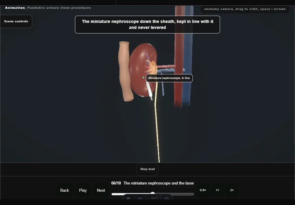 Paediatric urinary stone procedures. Step 6: The miniature nephroscope and the laser. Captured frame from the interactive animation.