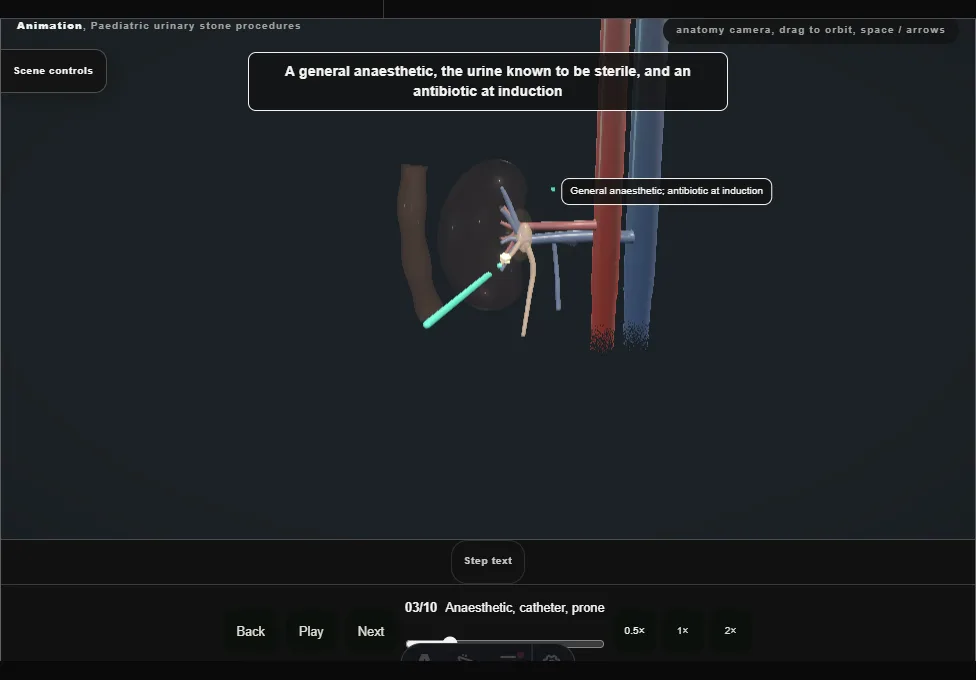 Paediatric urinary stone procedures. Step 3: Anaesthetic, catheter, prone. Captured frame from the interactive animation.