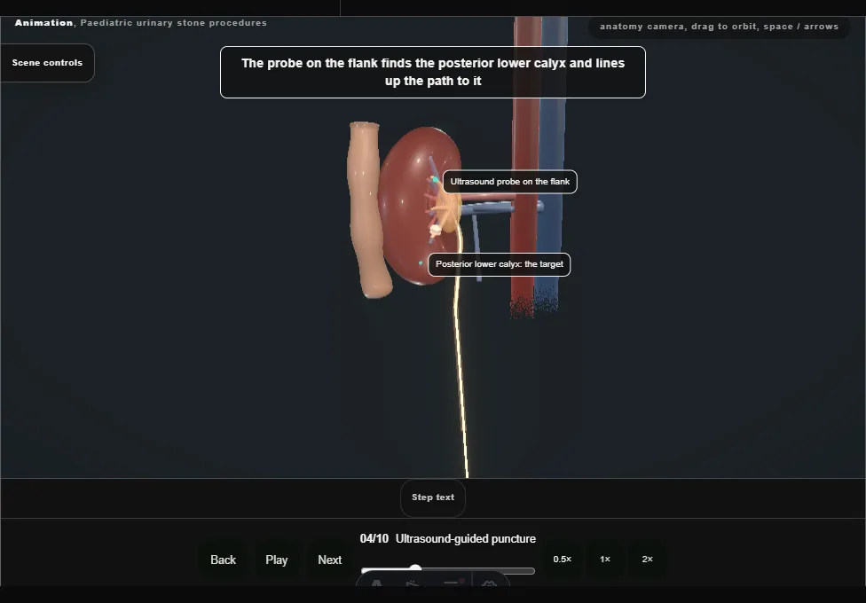 Paediatric urinary stone procedures. Step 4: Ultrasound-guided puncture. Captured frame from the interactive animation.