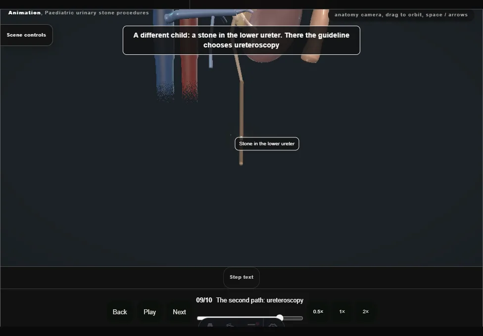 Paediatric urinary stone procedures. Step 9: The second path: ureteroscopy. Captured frame from the interactive animation.