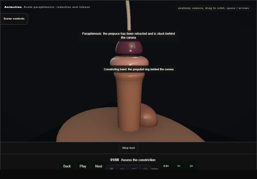 Acute paraphimosis: reduction and release. Step 1: Assess the constriction. Captured frame from the interactive animation.