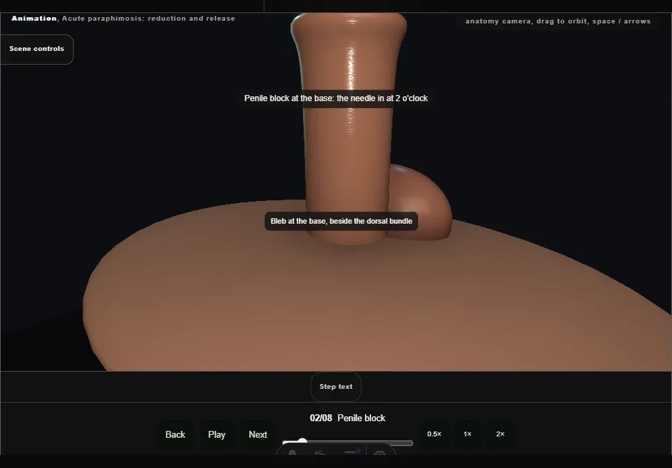 Acute paraphimosis: reduction and release. Step 2: Penile block. Captured frame from the interactive animation.