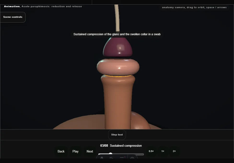 Acute paraphimosis: reduction and release. Step 3: Sustained compression. Captured frame from the interactive animation.