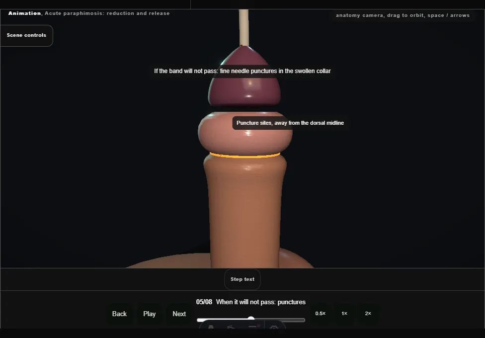 Acute paraphimosis: reduction and release. Step 5: When it will not pass: punctures. Captured frame from the interactive animation.
