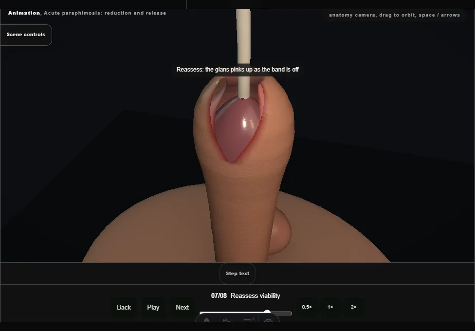 Acute paraphimosis: reduction and release. Step 7: Reassess viability. Captured frame from the interactive animation.