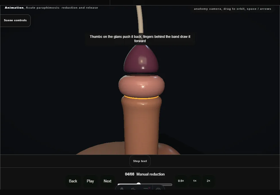 Acute paraphimosis: reduction and release. Step 4: Manual reduction. Captured frame from the interactive animation.