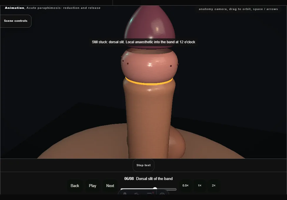 Acute paraphimosis: reduction and release. Step 6: Dorsal slit of the band. Captured frame from the interactive animation.