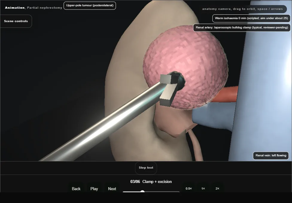 Partial nephrectomy. Step 3: Clamp + excision. Captured frame from the interactive animation.