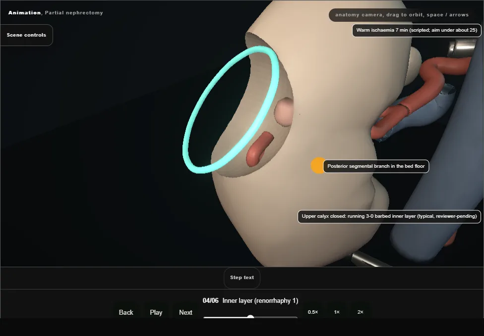Partial nephrectomy. Step 4: Inner layer (renorrhaphy 1). Captured frame from the interactive animation.