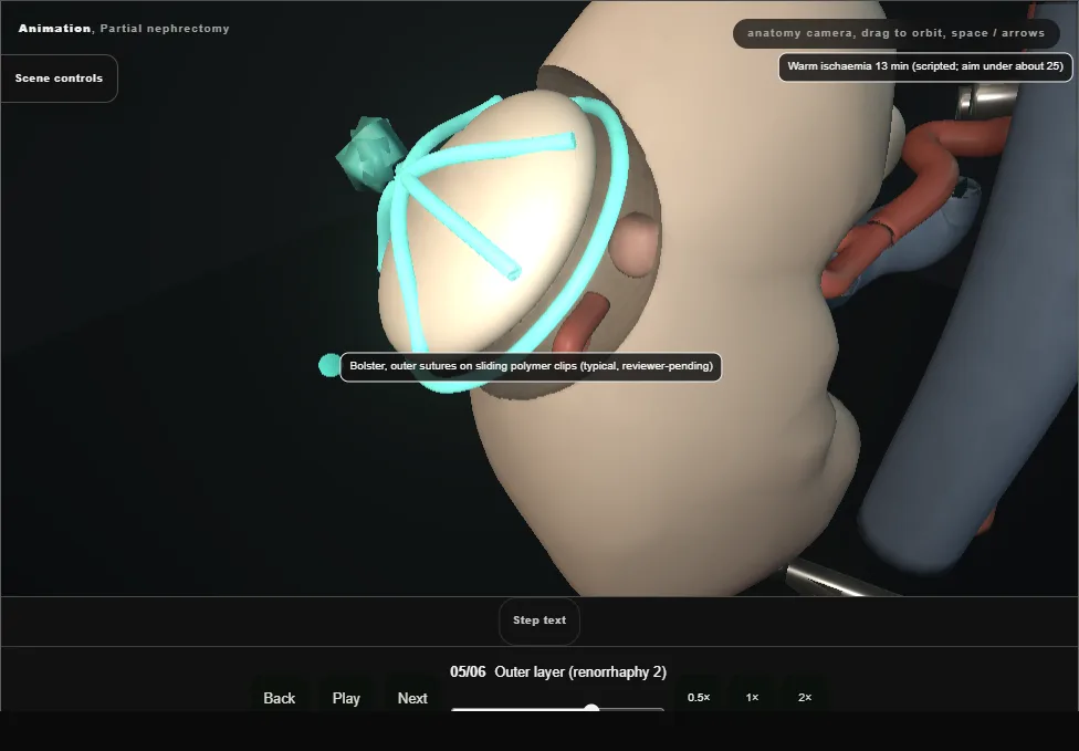 Partial nephrectomy. Step 5: Outer layer (renorrhaphy 2). Captured frame from the interactive animation.