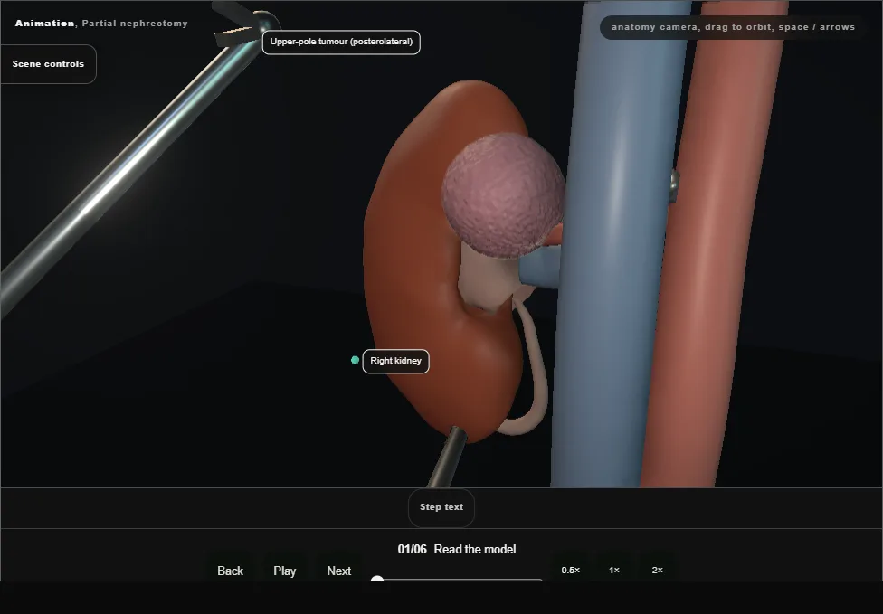 Partial nephrectomy. Step 1: Read the model. Captured frame from the interactive animation.
