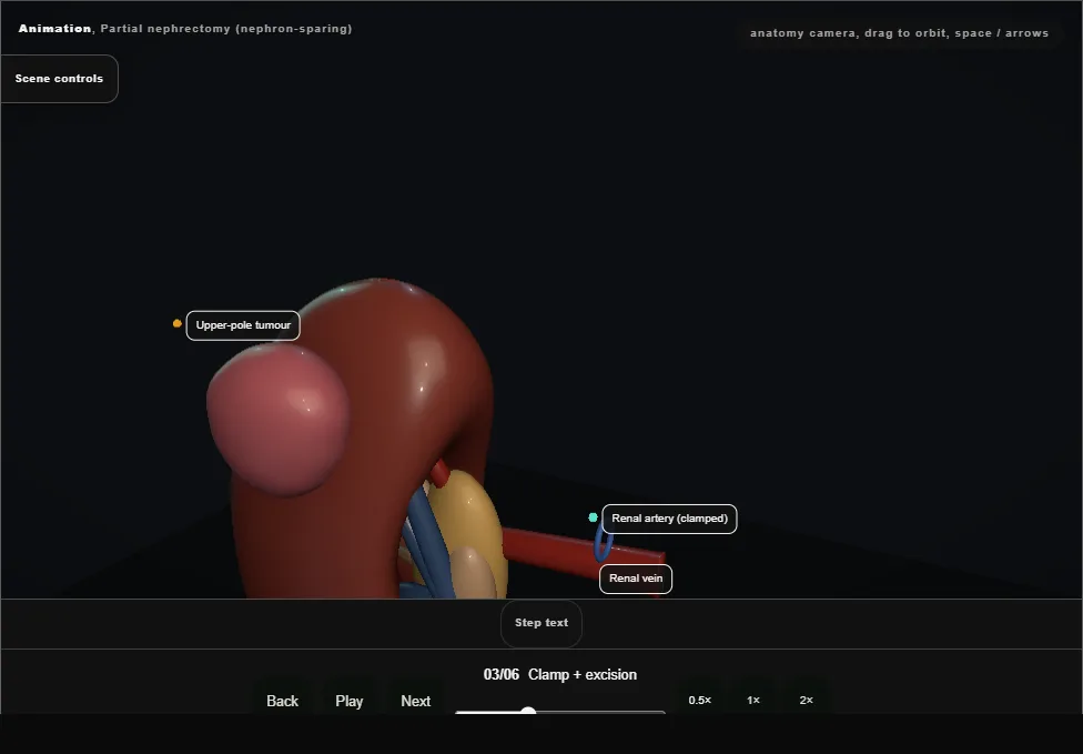 Partial nephrectomy (nephron-sparing). Step 3: Clamp + excision. Captured frame from the interactive animation.