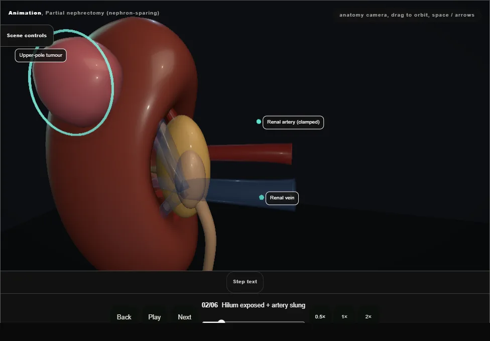 Partial nephrectomy (nephron-sparing). Step 2: Hilum exposed + artery slung. Captured frame from the interactive animation.
