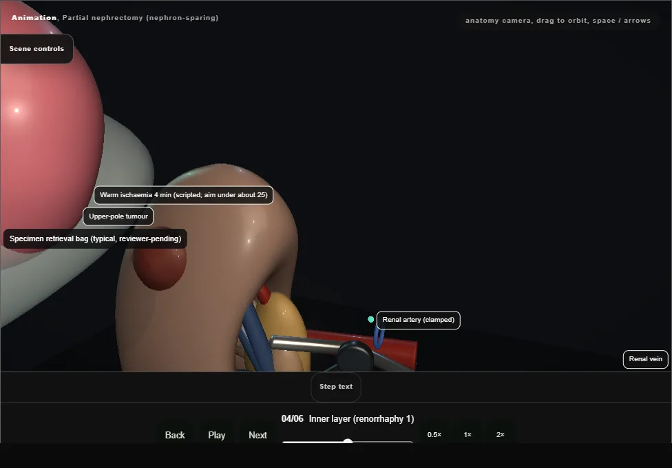 Partial nephrectomy (nephron-sparing). Step 4: Inner layer (renorrhaphy 1). Captured frame from the interactive animation.