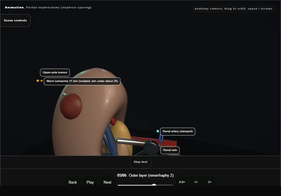 Partial nephrectomy (nephron-sparing). Step 5: Outer layer (renorrhaphy 2). Captured frame from the interactive animation.