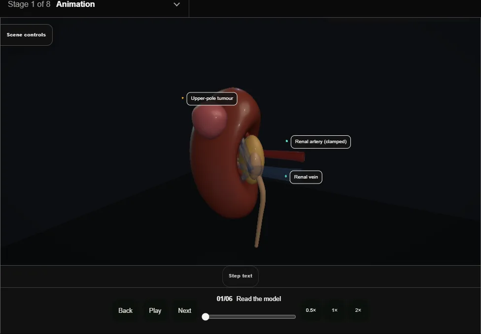 Partial nephrectomy (nephron-sparing). Step 1: Read the model. Captured frame from the interactive animation.