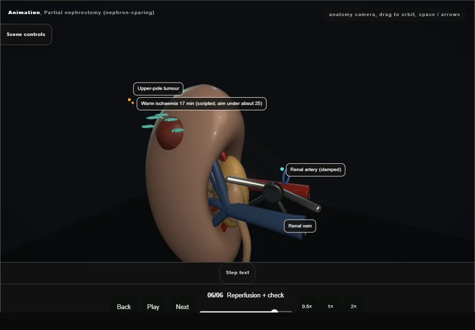 Partial nephrectomy (nephron-sparing). Step 6: Reperfusion + check. Captured frame from the interactive animation.