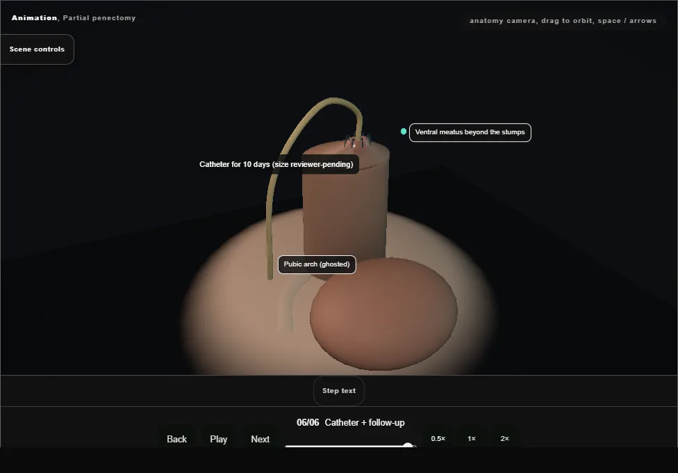 Partial penectomy. Step 6: Catheter + follow-up. Captured frame from the interactive animation.